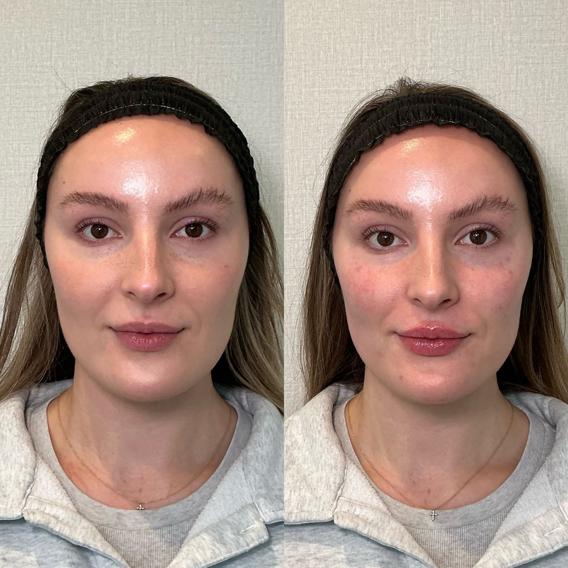 Side-by-side portrait showing the same woman with a natural look on the left and a flushed face on the right.