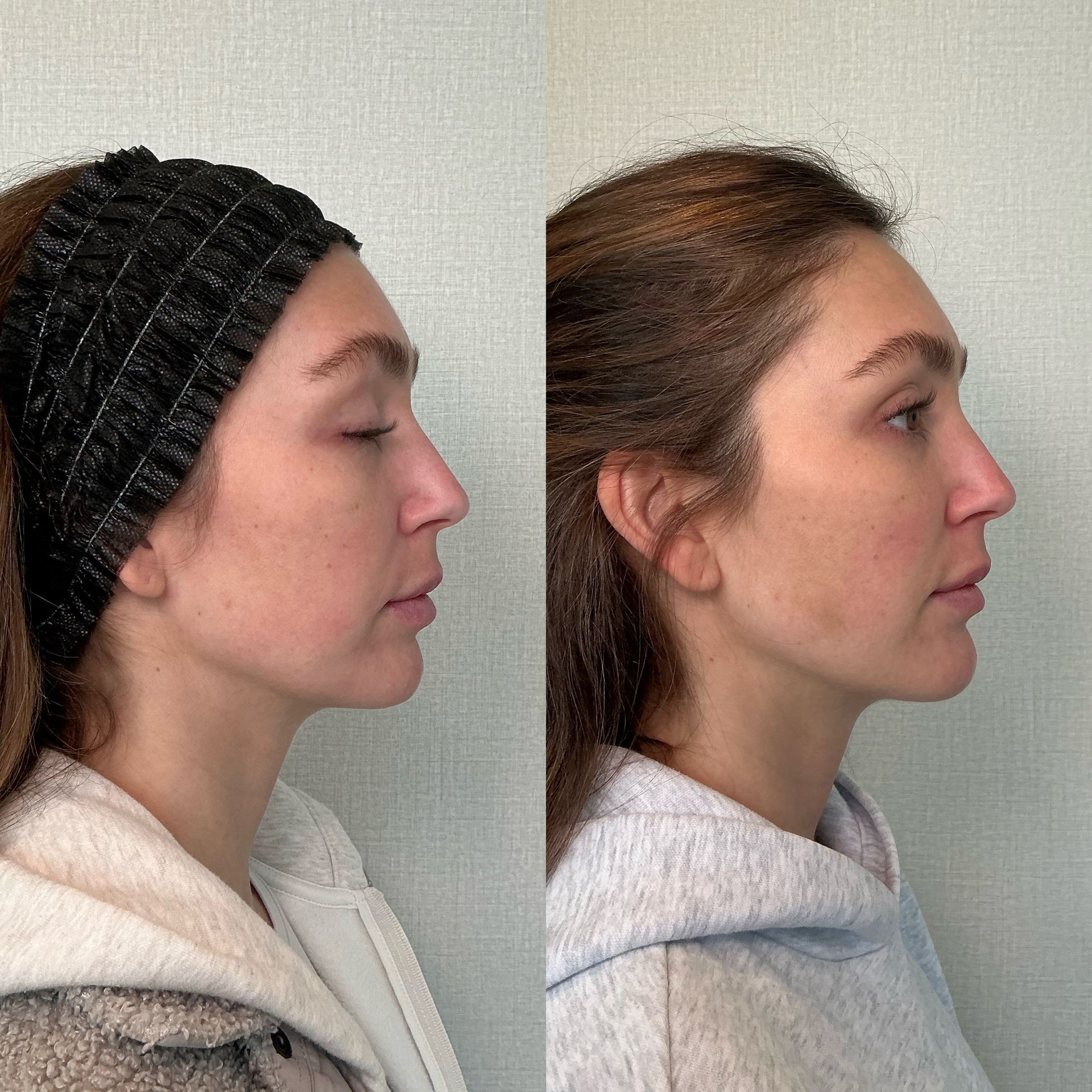 Side-by-side profile views of a person before and after a facial or neck profile change.