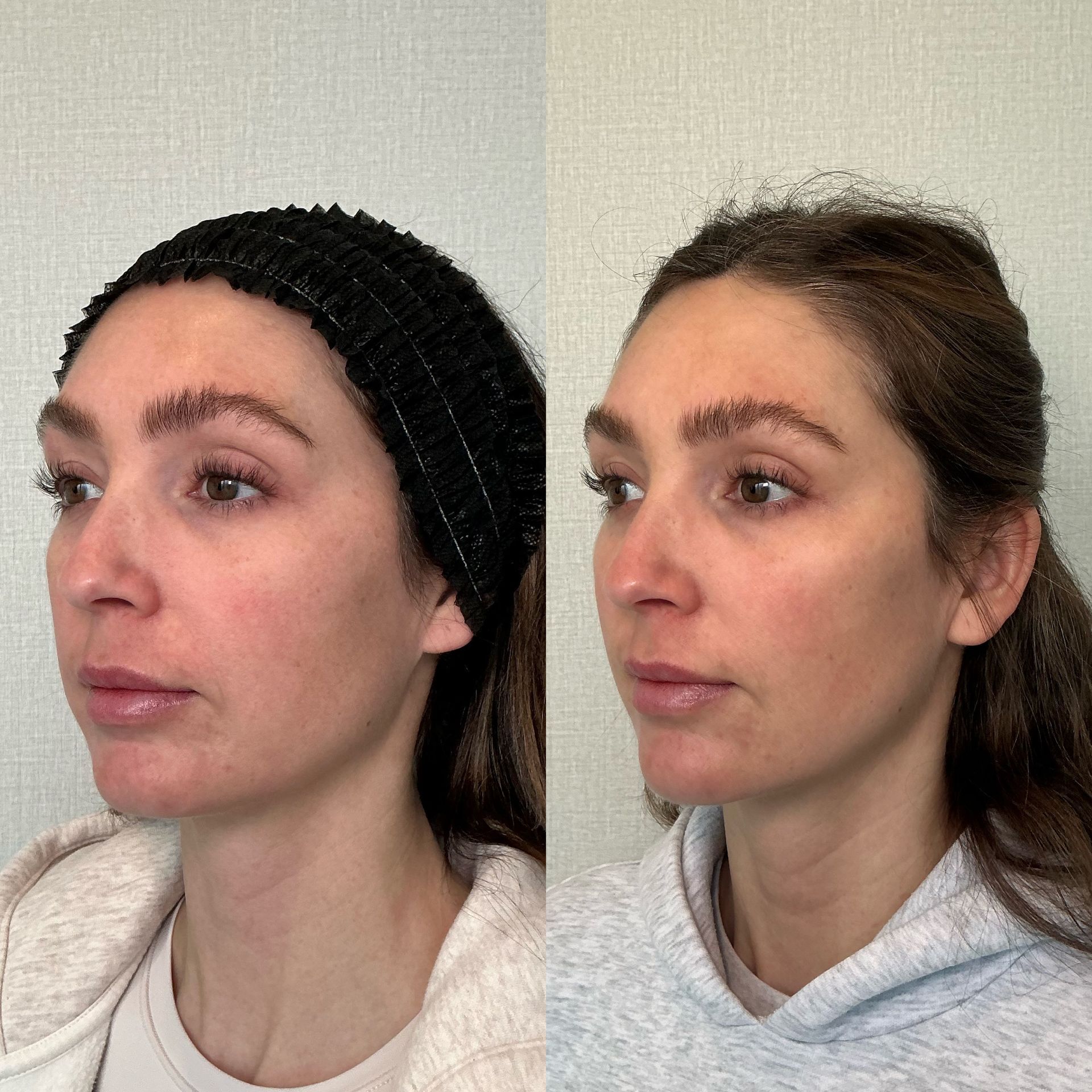 Side-by-side facial profile comparison of the same person wearing a black beanie and a white hoodie.