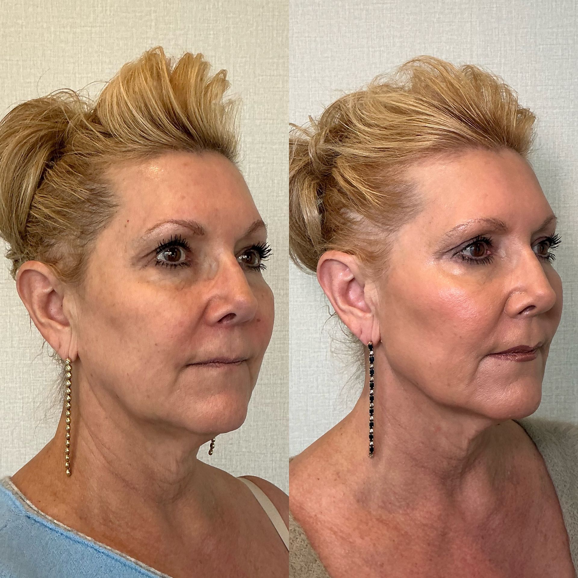 Side-by-side facial profile comparison of a woman before and after cosmetic treatment
