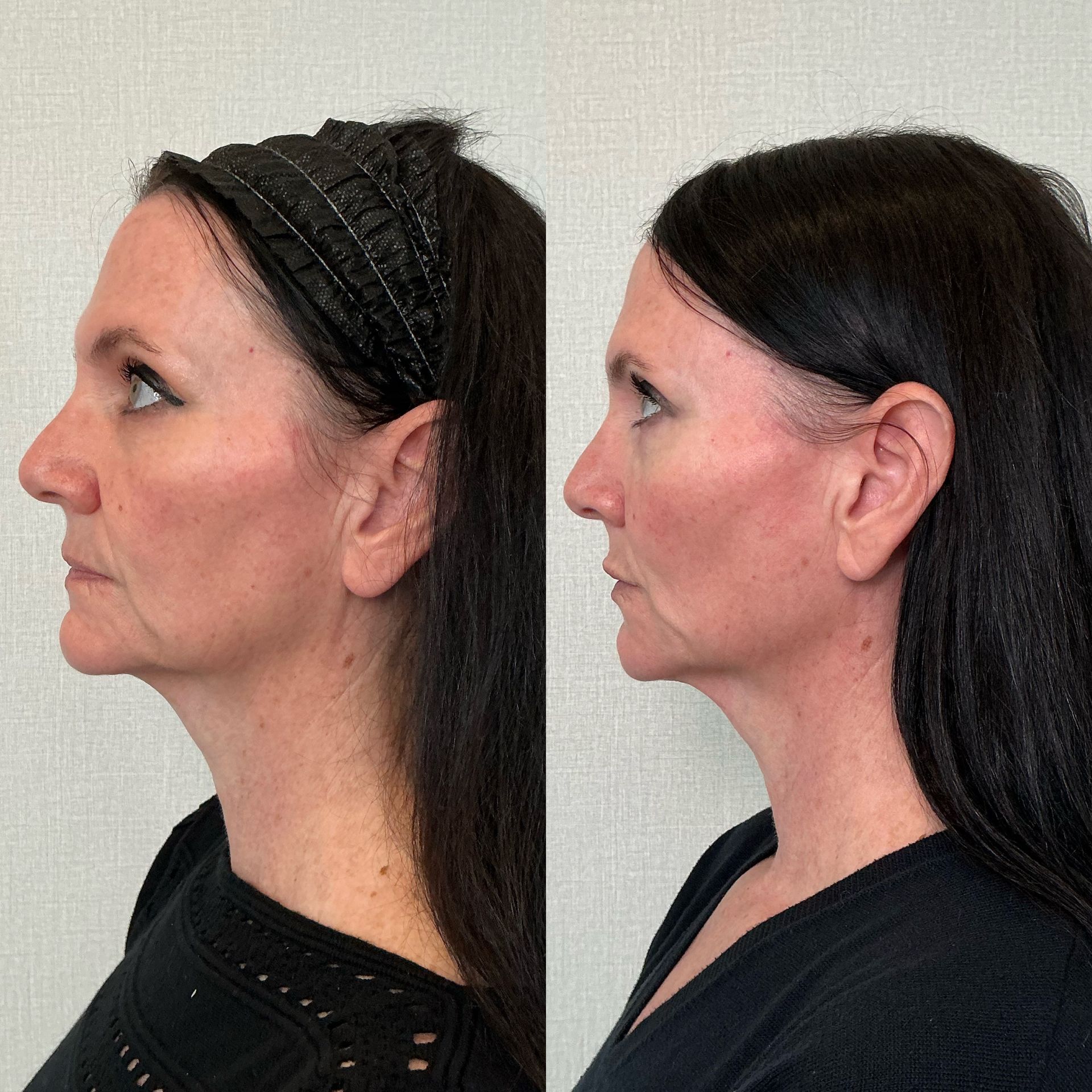 Side profile comparison of a woman before and after a neck lift, showing smoother neck and jawline on the right