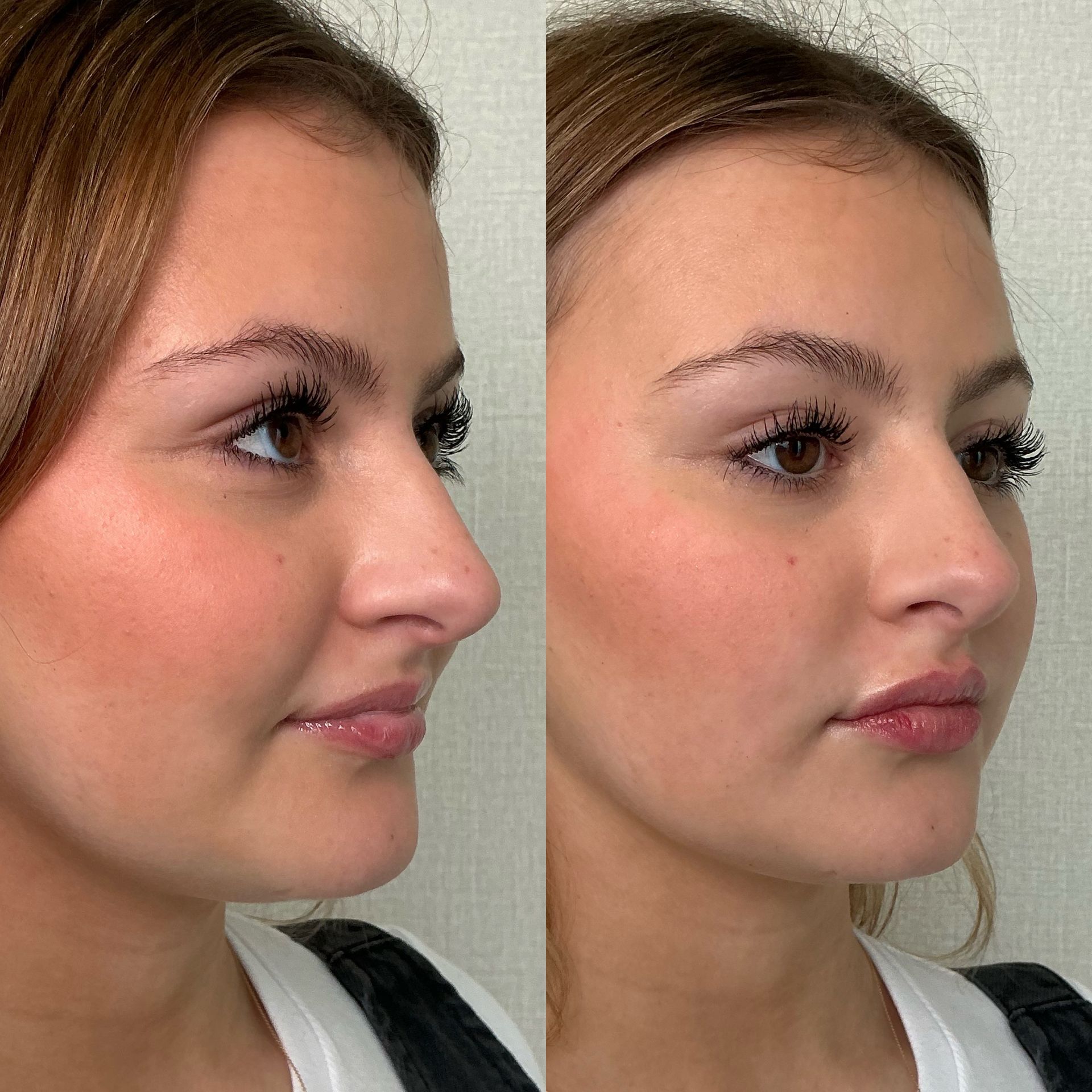 Side-by-side profile photos of a woman, showing a before-and-after facial appearance.
