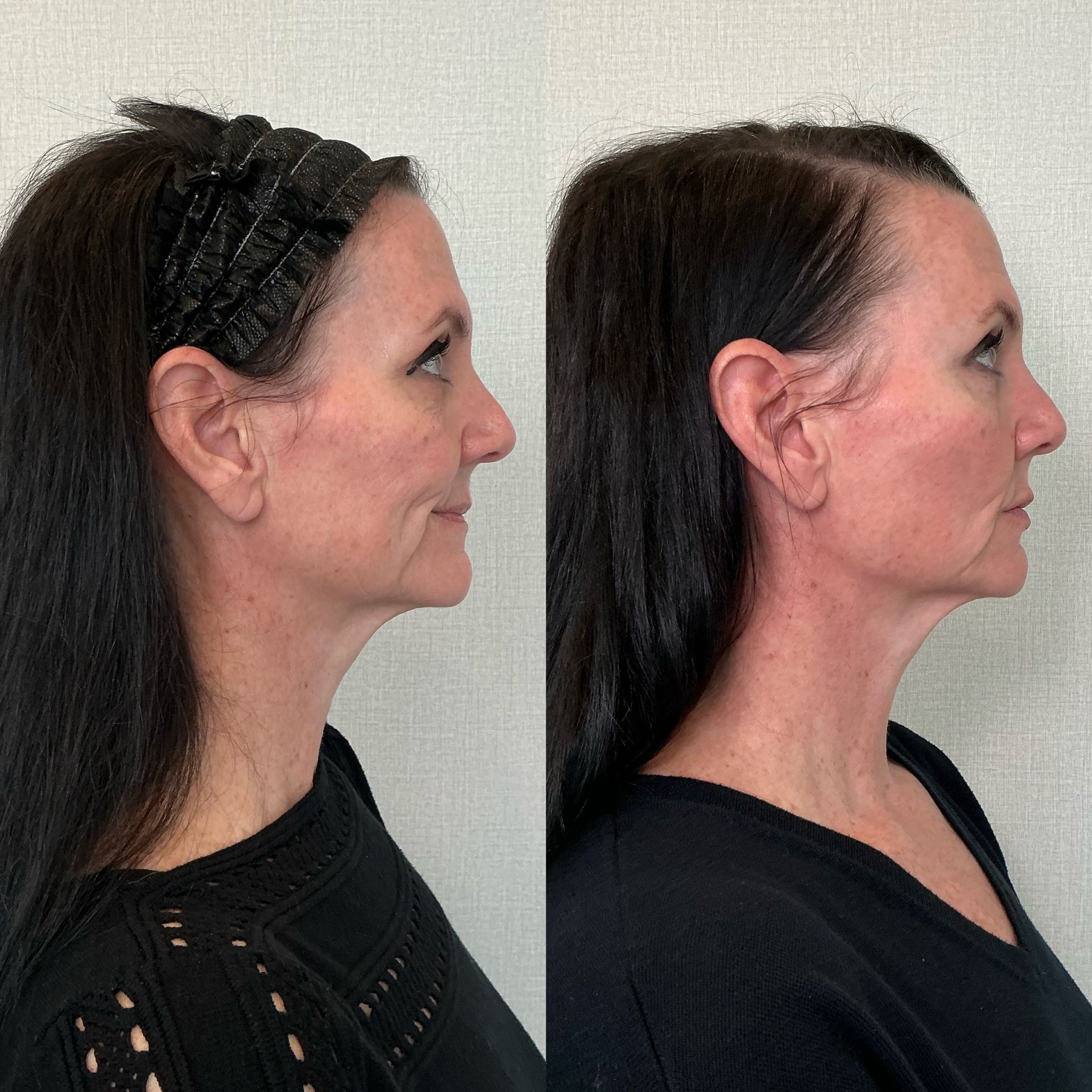 Two side-profile photos of a woman with dark hair, showing a facial profile comparison on a gray background.