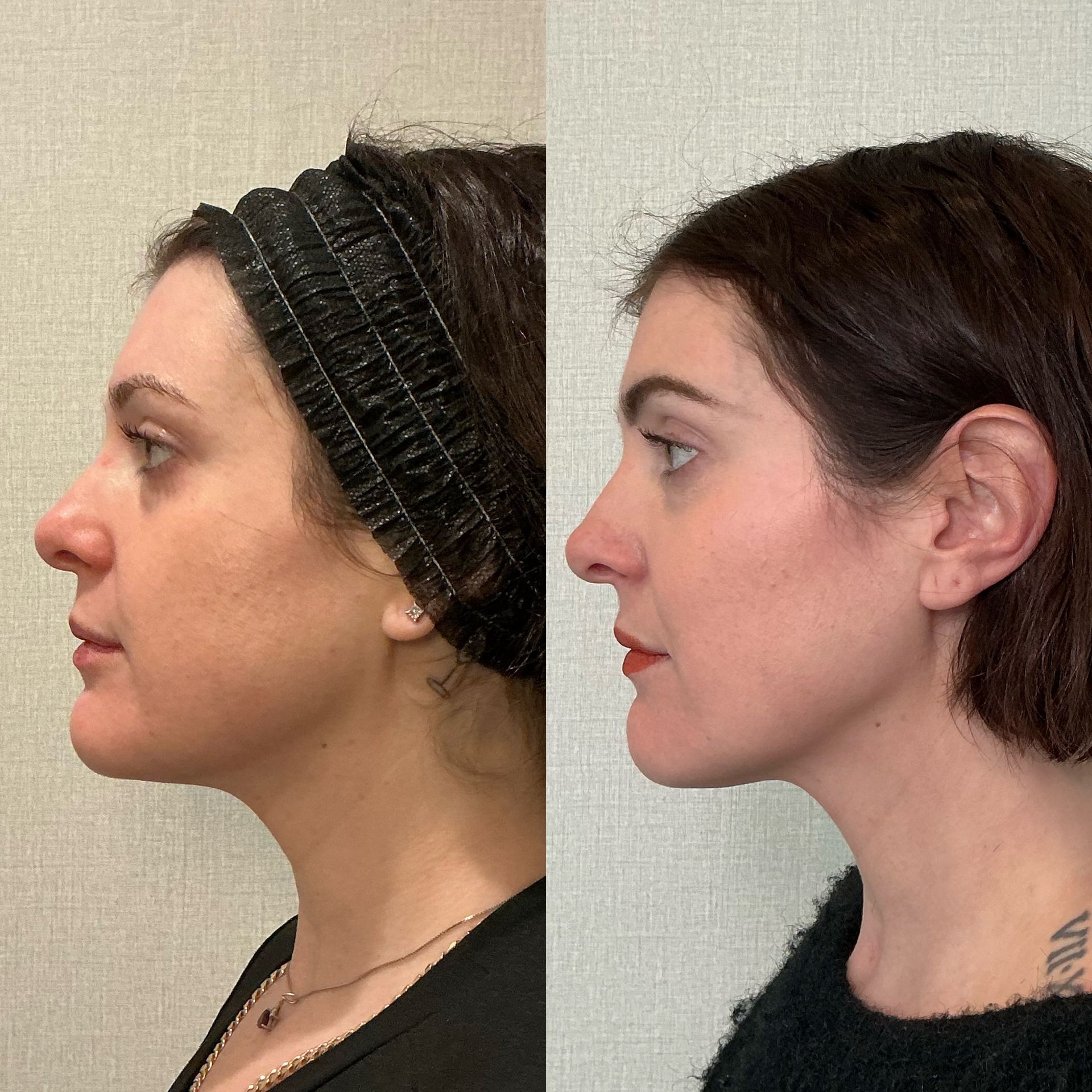 Side-by-side profile photos of the same woman, before and after a facial change, against a plain background