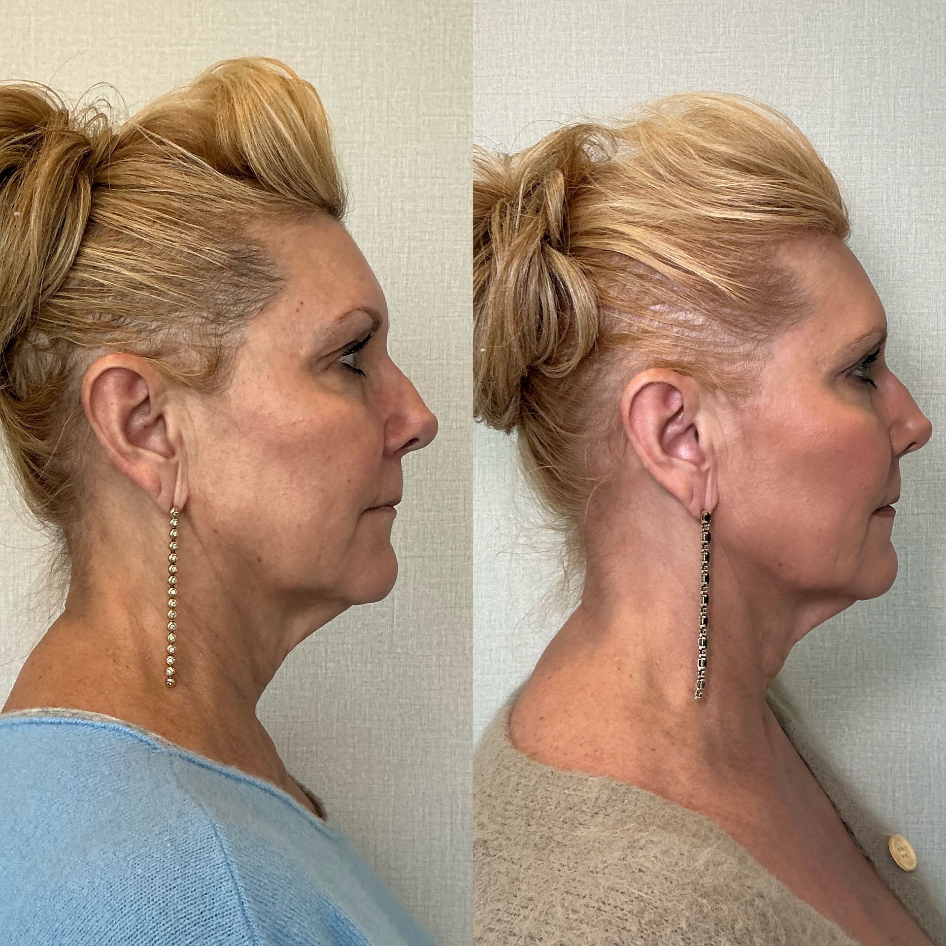 Side-profile before-and-after portraits of a woman with blonde hair, showing a chin and neck profile change.
