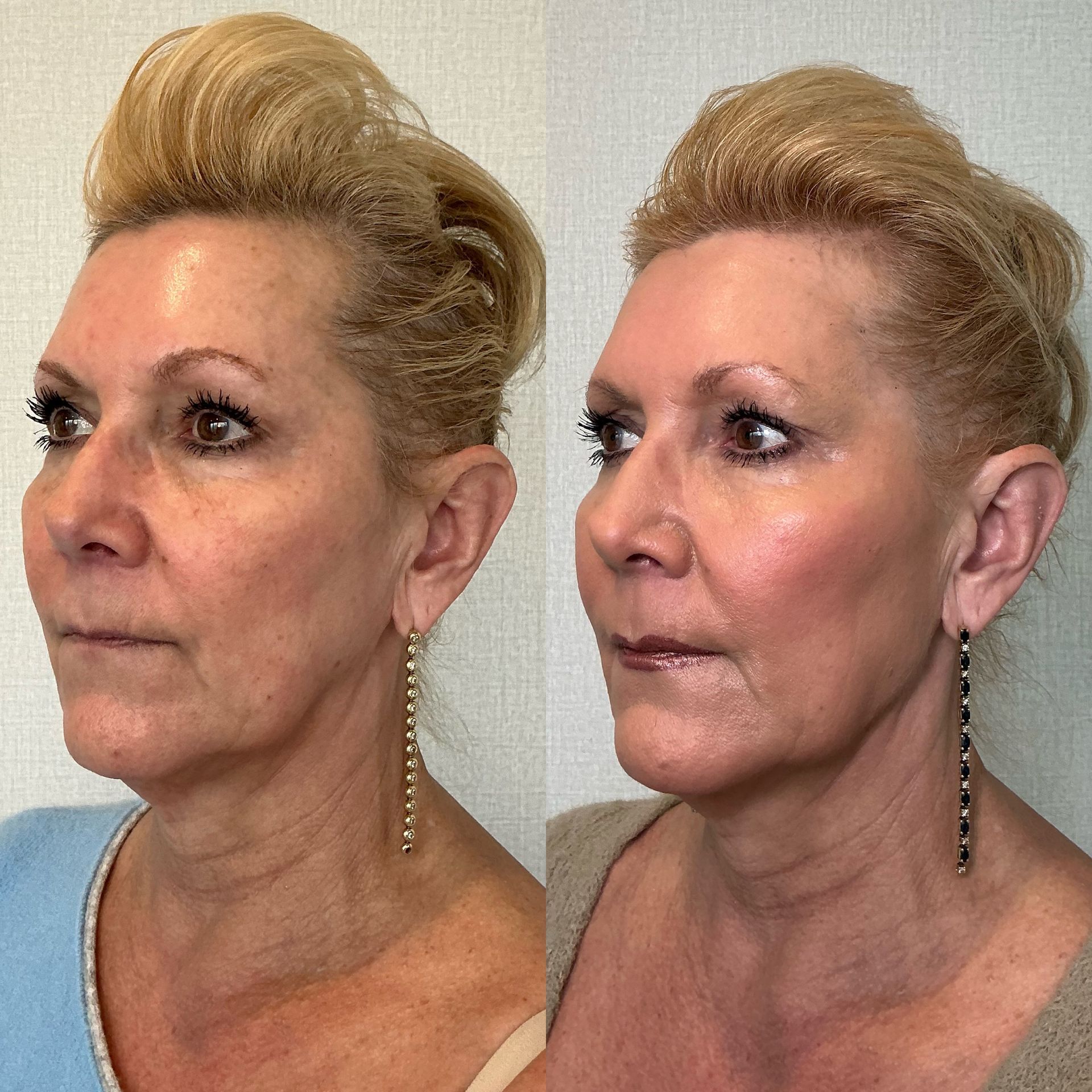 Side-by-side profile portraits of a woman before and after facial cosmetic treatment, in a studio setting