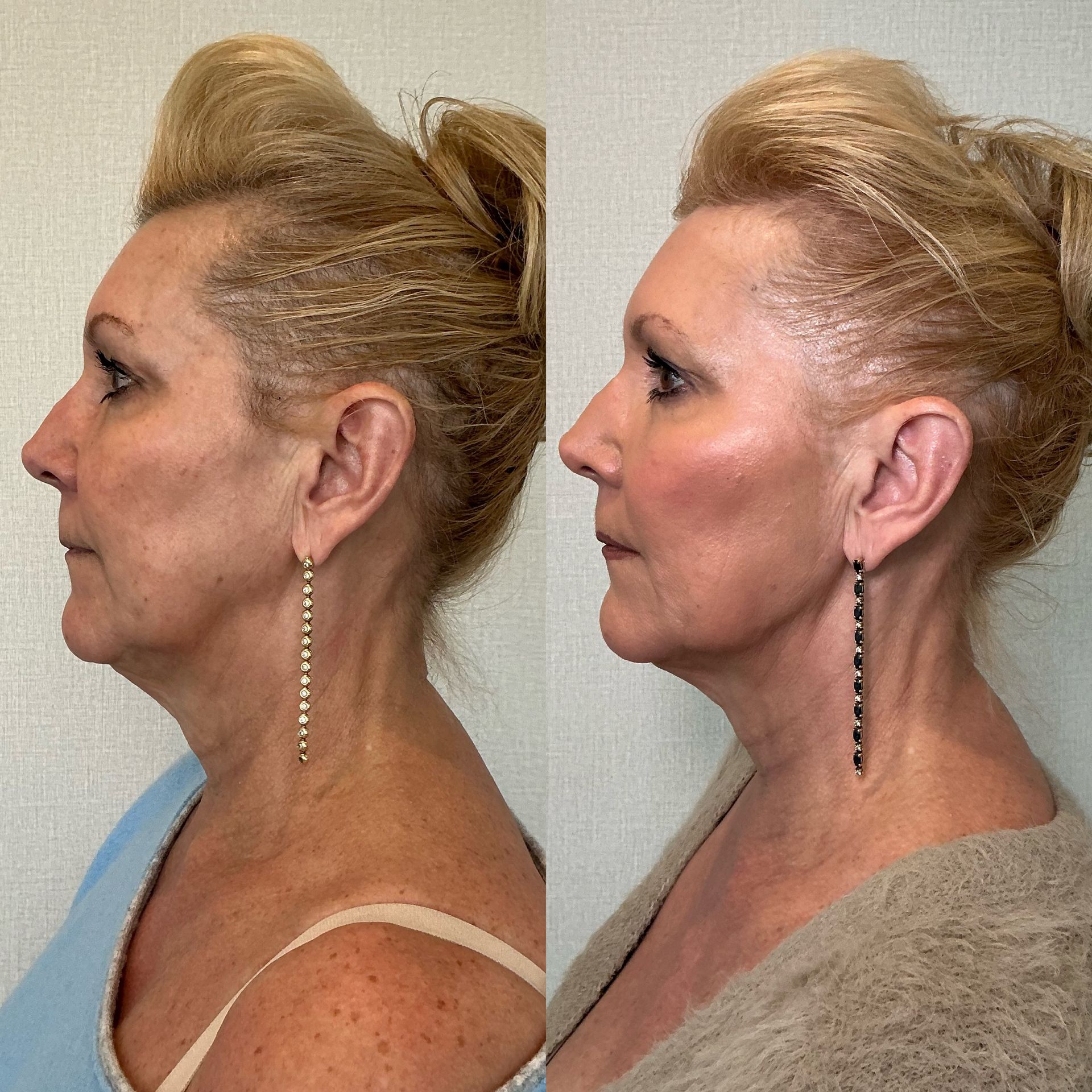 Side-by-side profile photos of a woman with a pulled-back blonde bun, showing before and after cosmetic results.