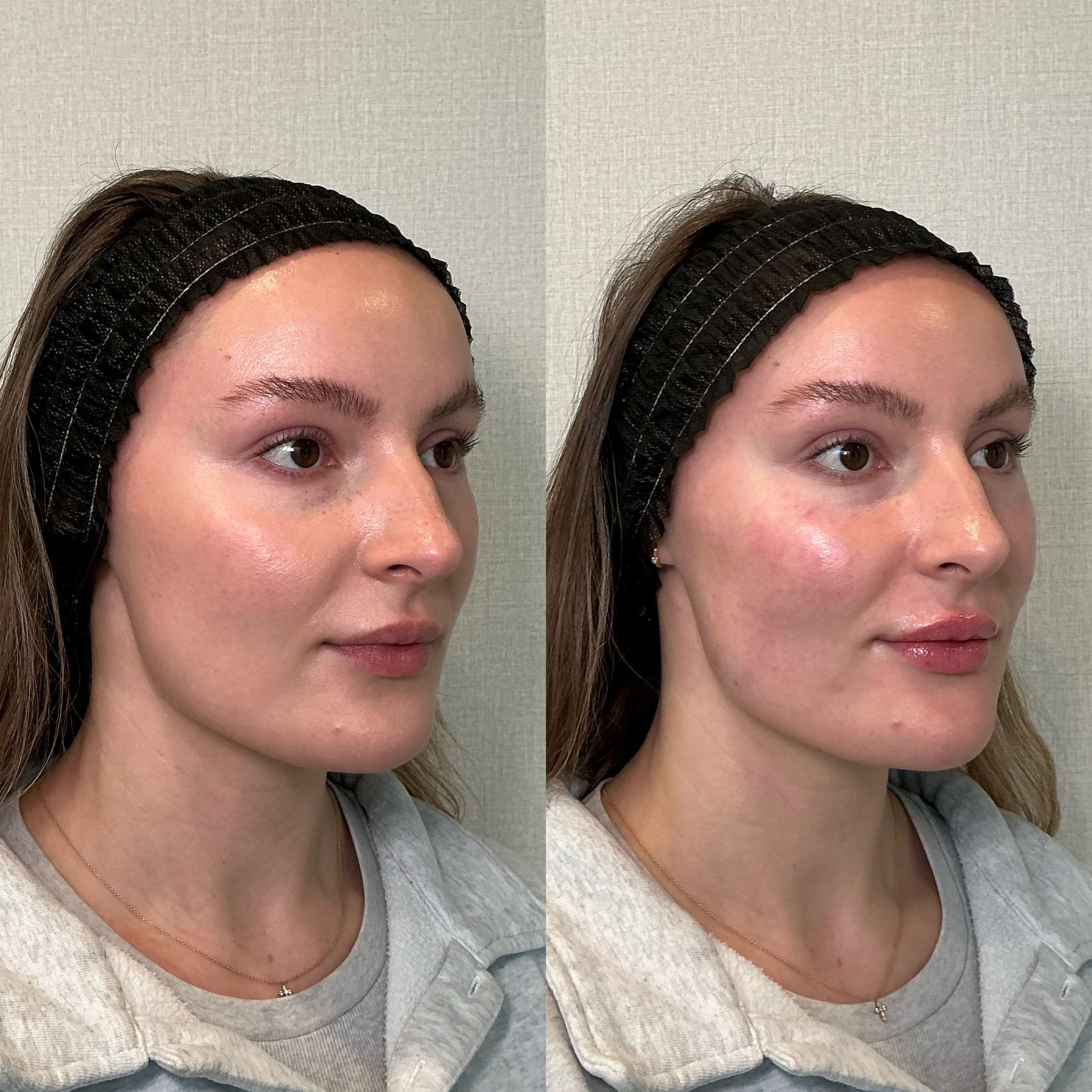 Side-by-side profile portraits of a woman wearing a black headband and gray top, facing right.