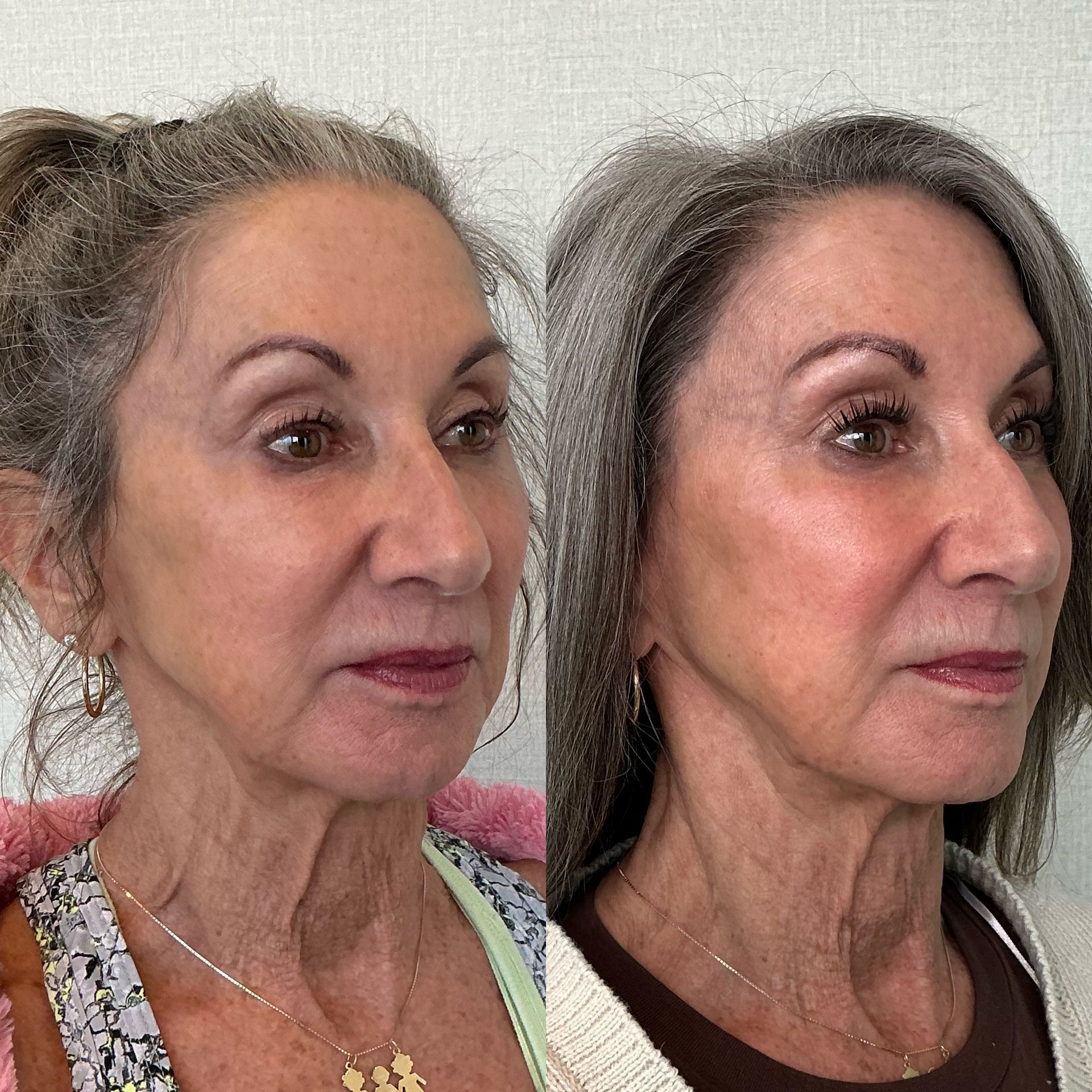 Side-by-side profile photos of the same woman indoors, showing a natural look and a slimmer jawline on the right.