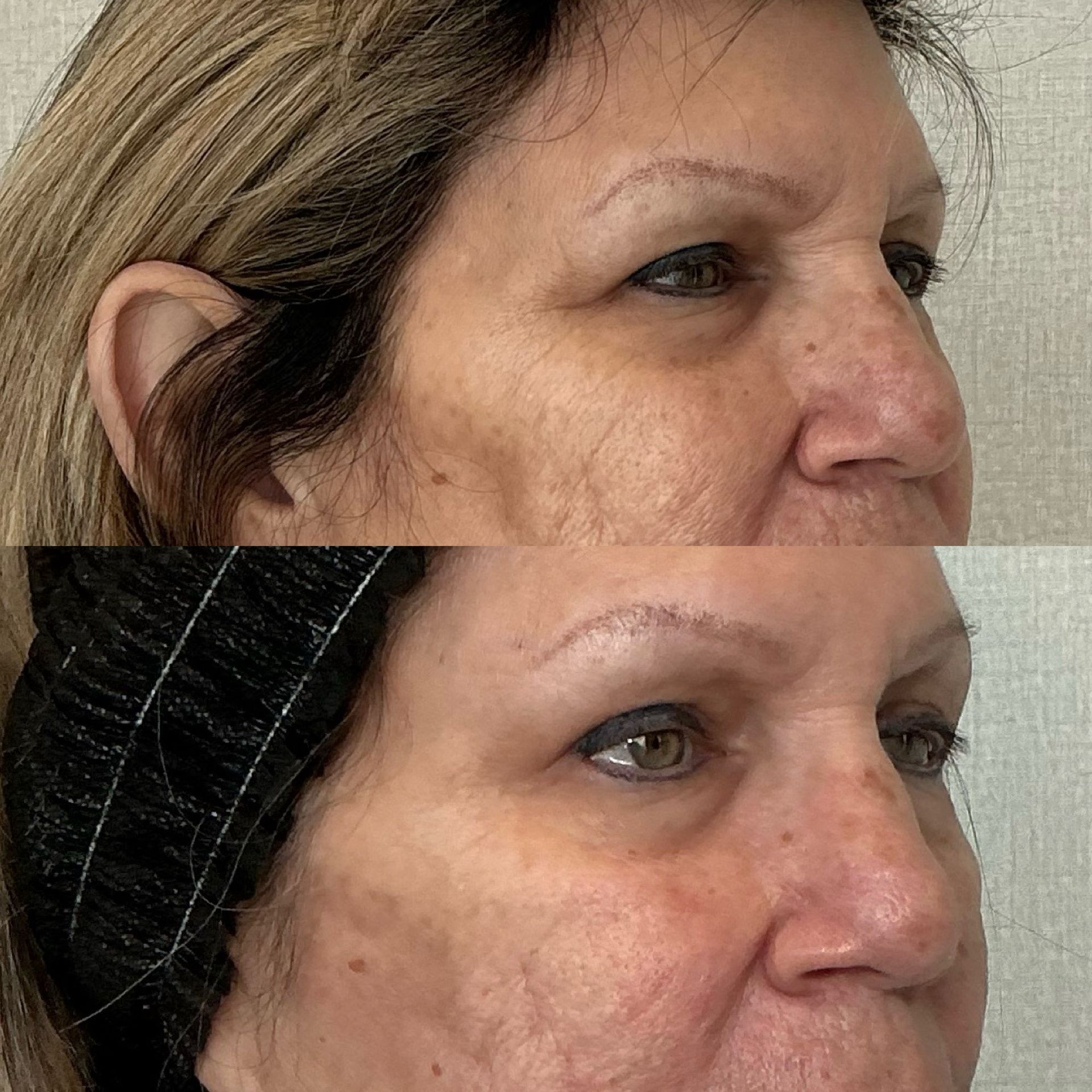Two side-profile views of a woman with a black headband, showing before-and-after facial changes