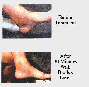Portrait of before and after using Bioflex laser