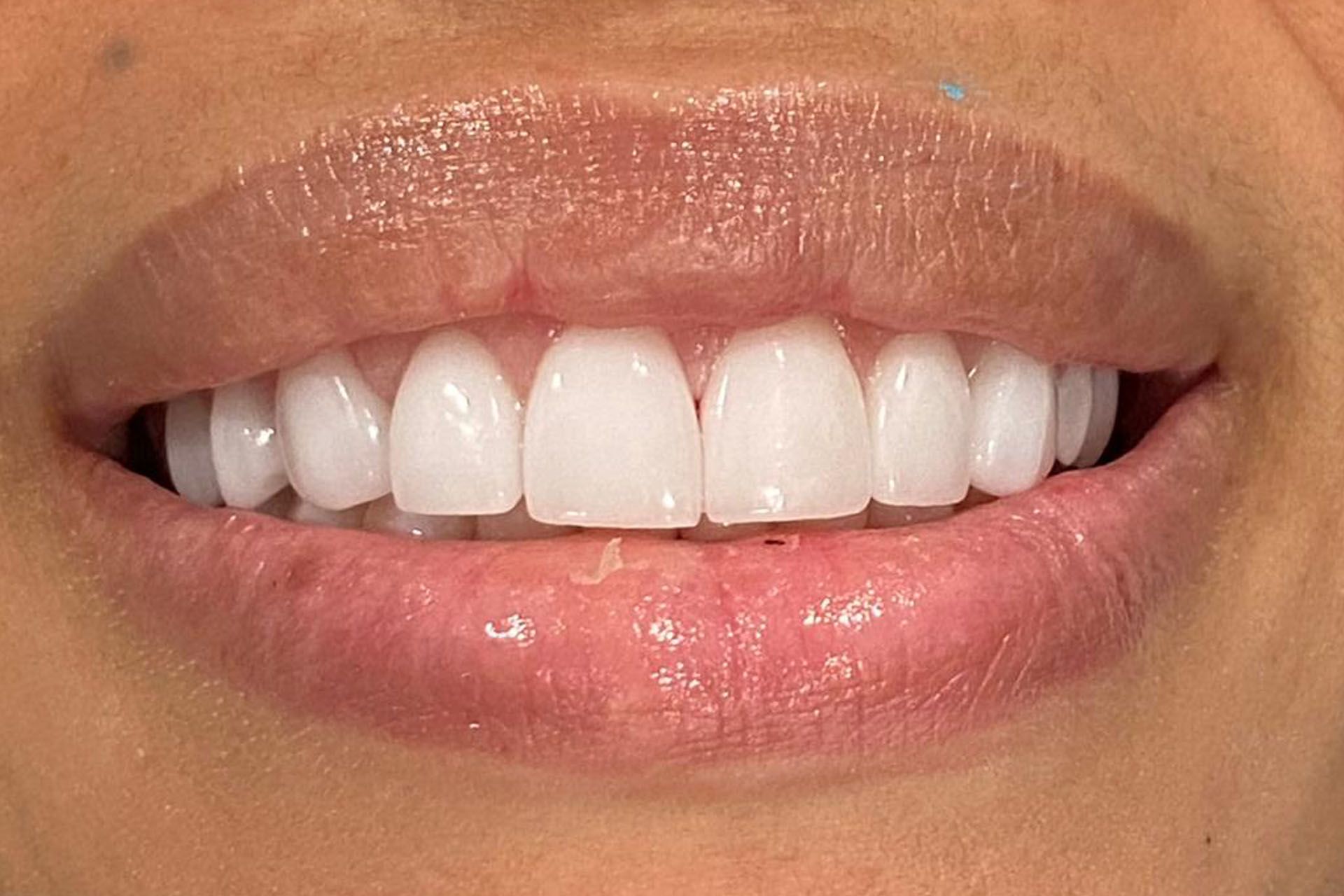 A close-up of a woman's mouth with white teeth.