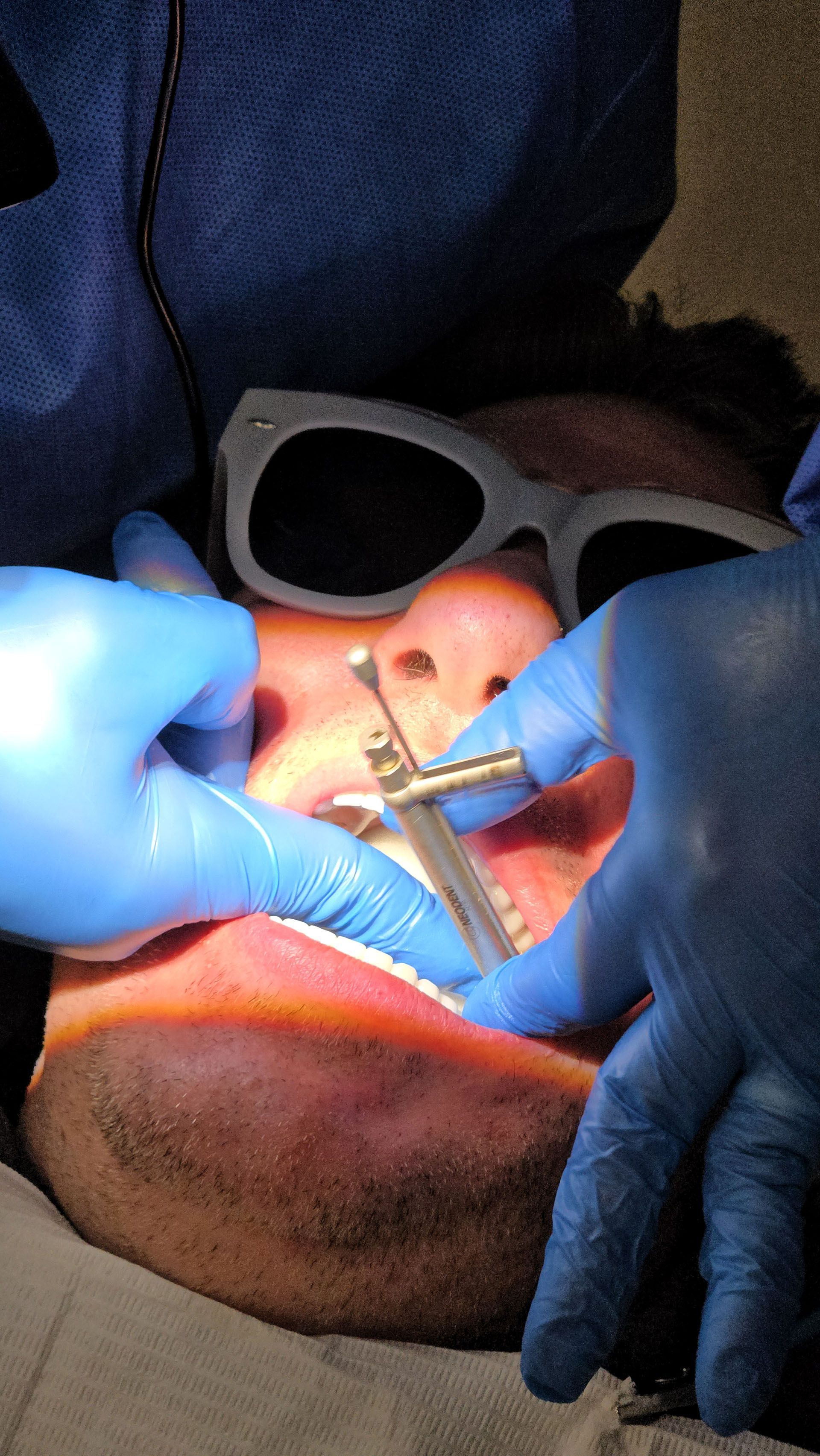 All On Four Implants - A person is getting their teeth examined by a dentist.