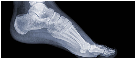 Foot and ankle pain