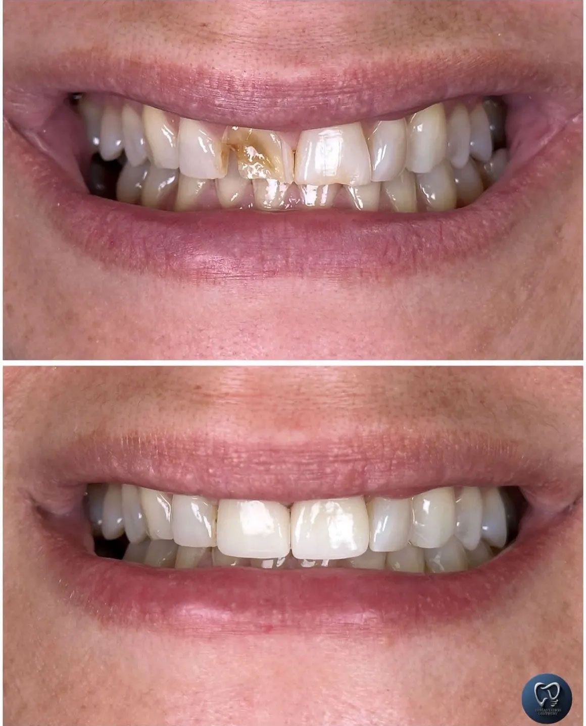 Top: damaged teeth. Bottom: restored white teeth. Close-up of smiling mouth.