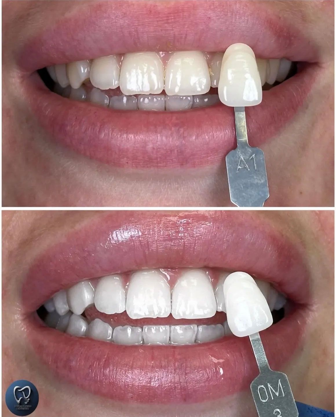 Comparison of teeth color with shade guide before and after whitening.
