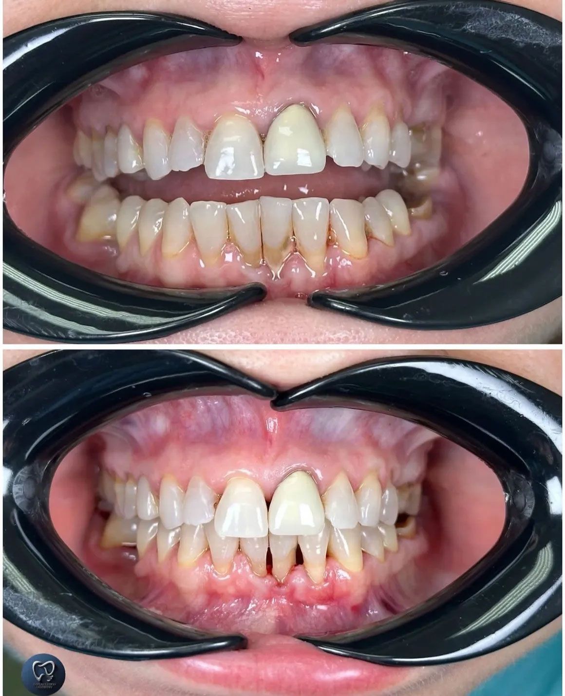 Side-by-side comparison of teeth. The top shows a whiter tooth, bottom shows the original teeth.