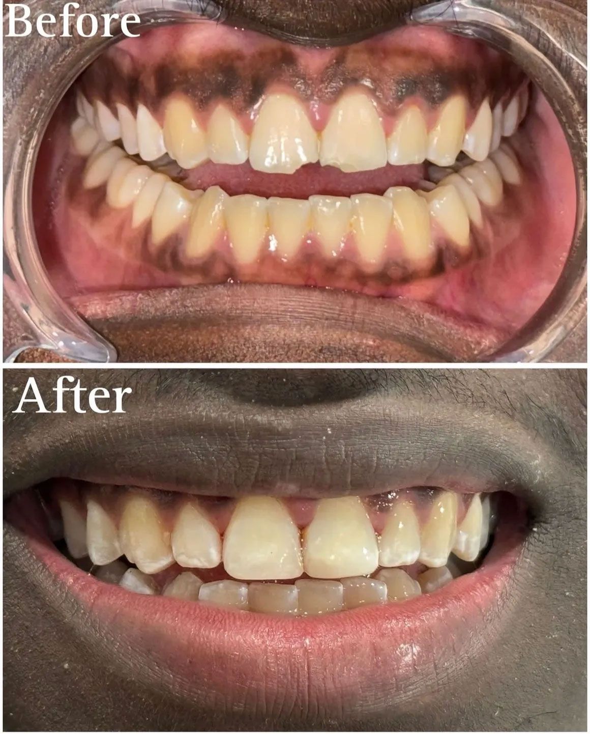 Comparison of teeth before and after whitening. Shows yellowed teeth becoming brighter.