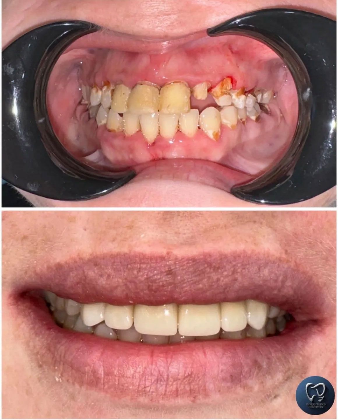Top: Mouth with damaged teeth. Bottom: person smiling with new, white teeth.