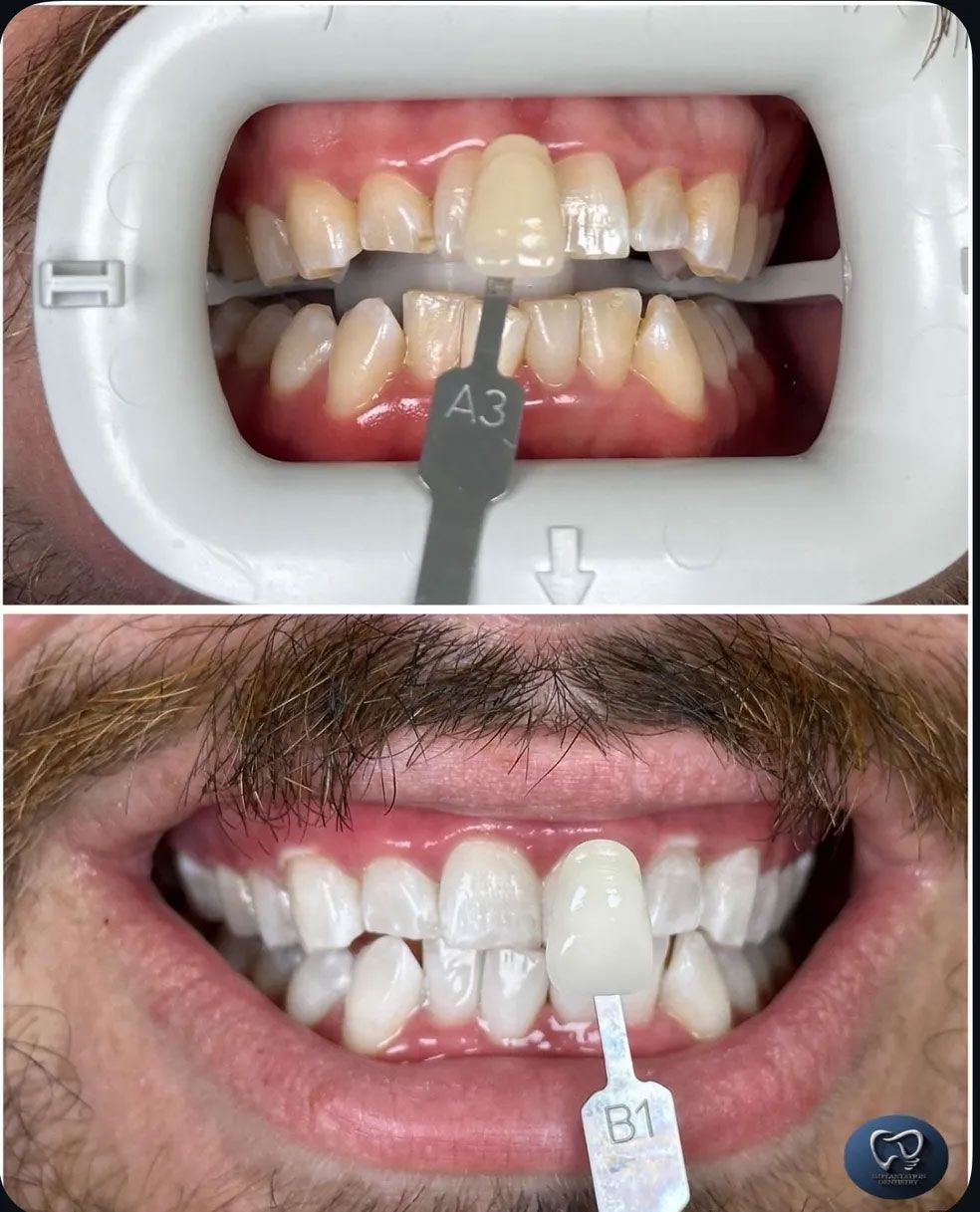 Before-and-after teeth whitening comparison. Top shows stained teeth, bottom shows whiter teeth with a shade guide.