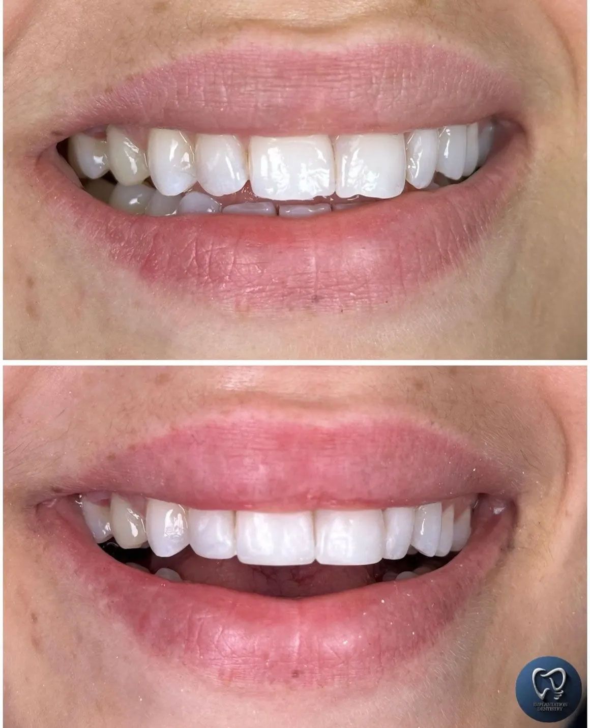 Top: Crooked teeth. Bottom: Perfectly aligned, white teeth.