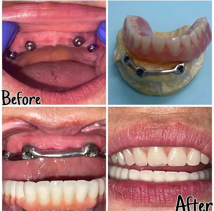 Dental implant procedure: before and after photos showing implants, bar, and new teeth.