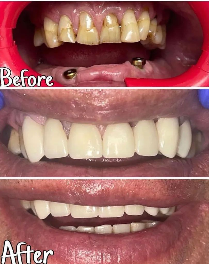 Dental comparison: upper teeth before and after restoration. Before: discolored teeth. After: white smile.