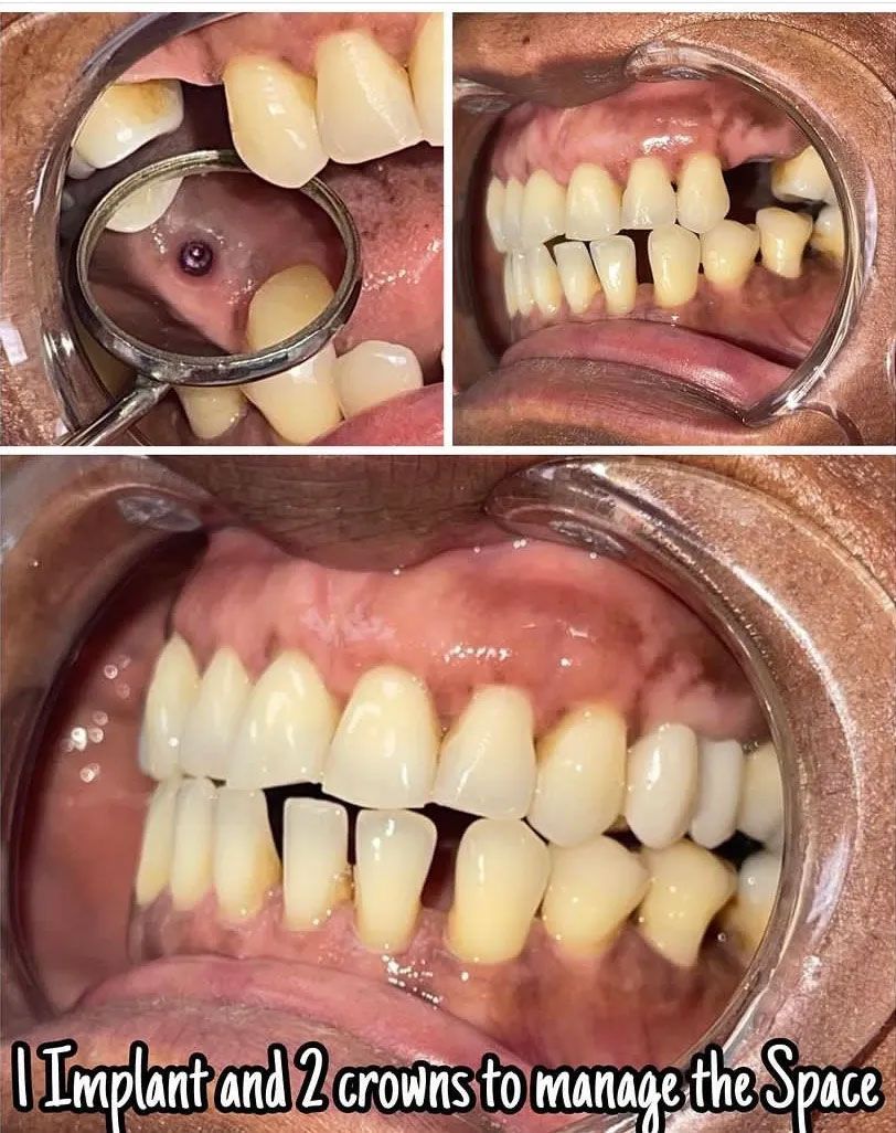 Dental images showing gaps and missing teeth. Text indicates planned dental implant and crowns to fill spaces.