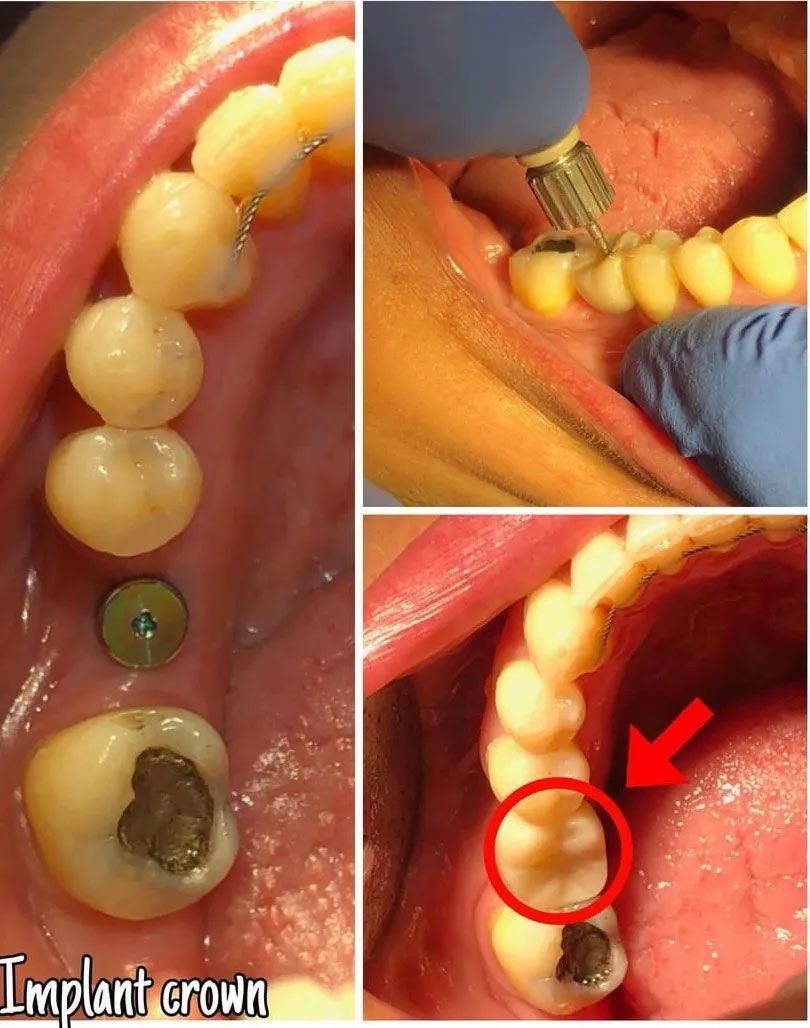 Dental implant procedure: crown placement, tool in mouth, and close-up of a damaged molar.