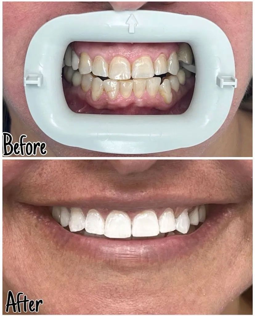 Side-by-side comparison of teeth. Upper photo shows before, teeth yellow with a mouth opener. Lower photo shows bright white teeth.