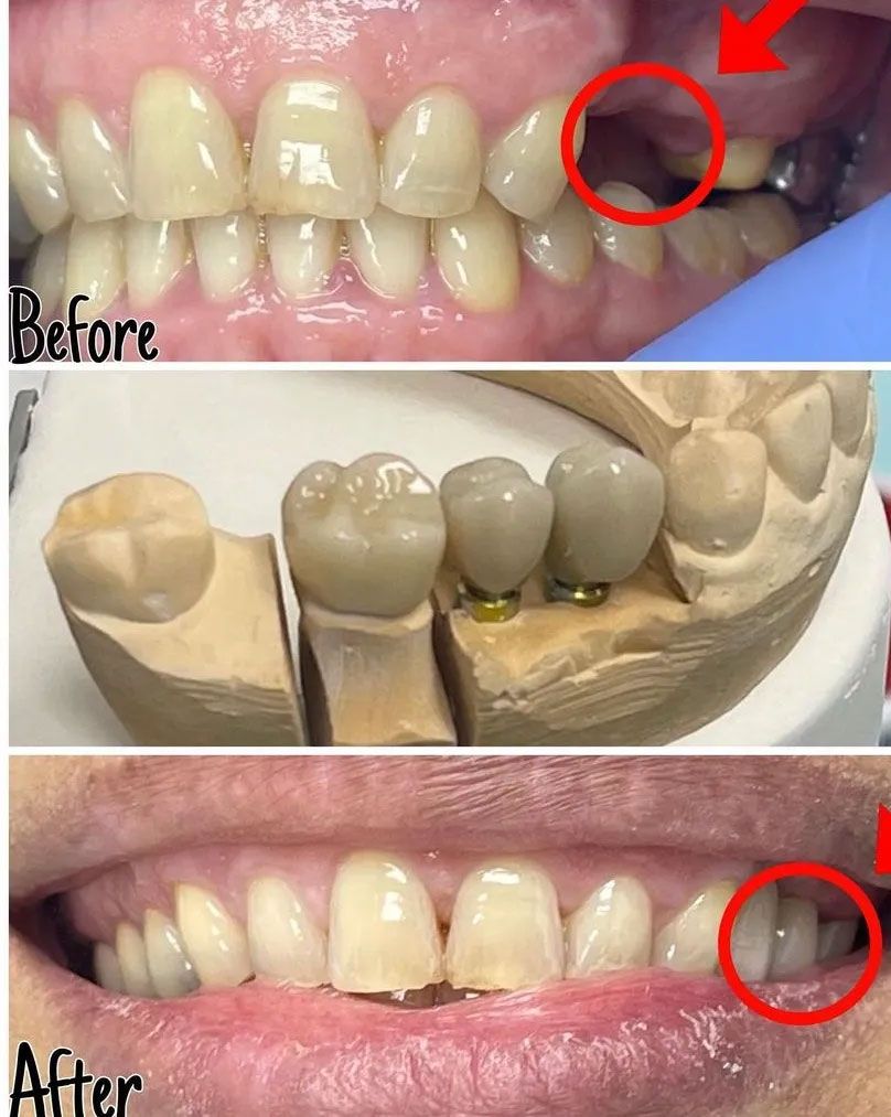 Comparison of teeth before and after dental work, showing a missing tooth replaced with a bridge.