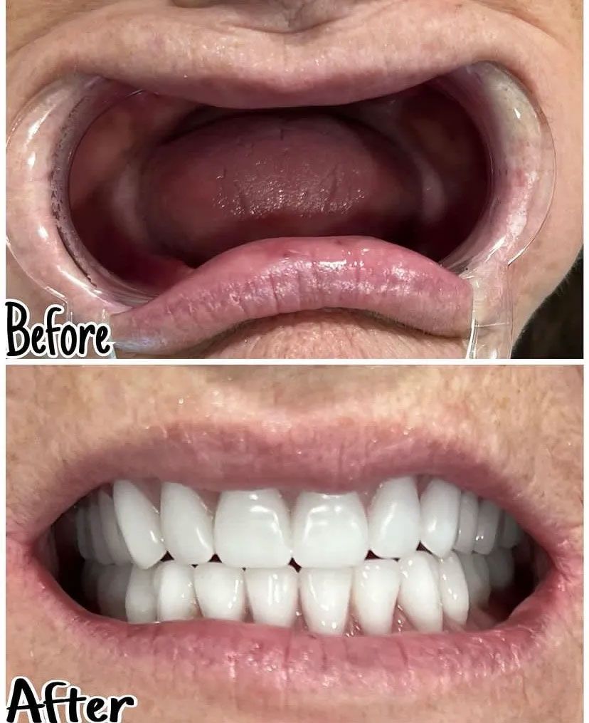 Side-by-side comparison: upper mouth before (missing teeth) and after (bright white, complete set).