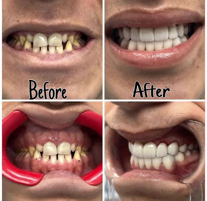 Side-by-side comparison: yellow, crooked teeth 