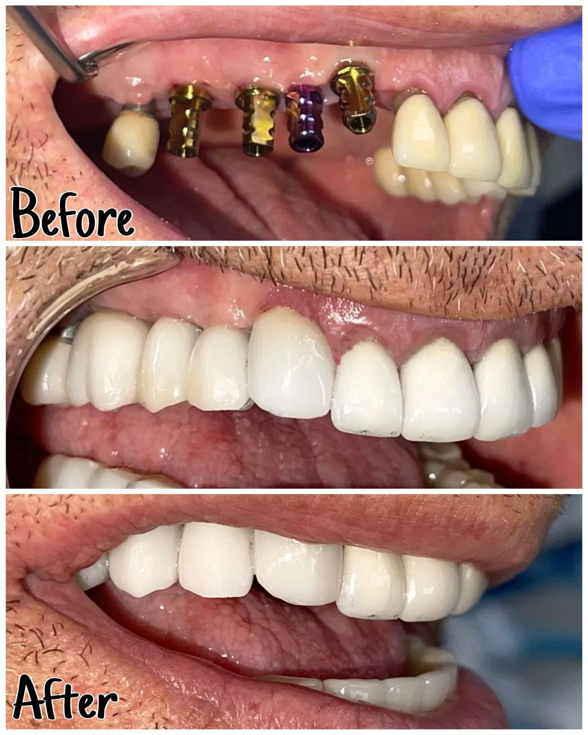 Dental implant procedure. Upper row: Before, with implant posts. Lower rows: After, showing new teeth.