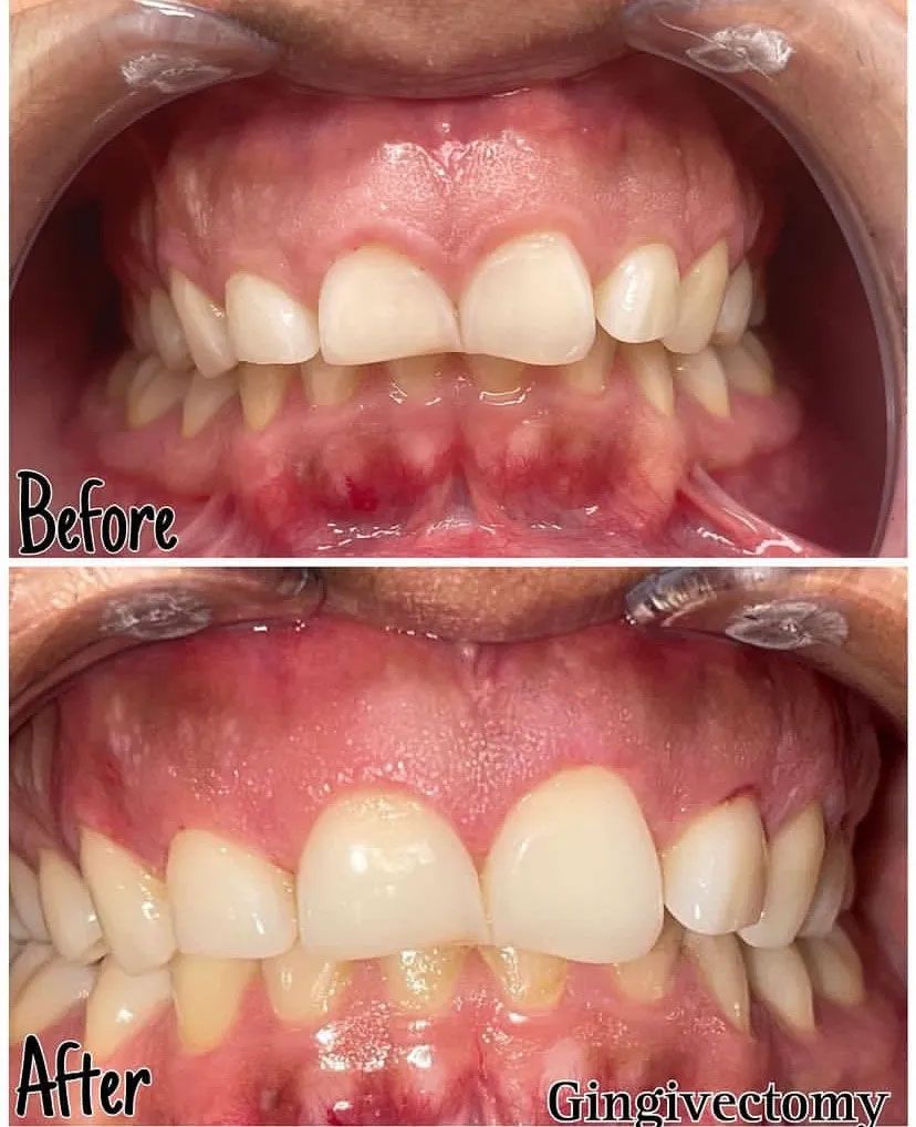 Side-by-side comparison of teeth before and after gingivectomy, showing improved gum line and tooth appearance.