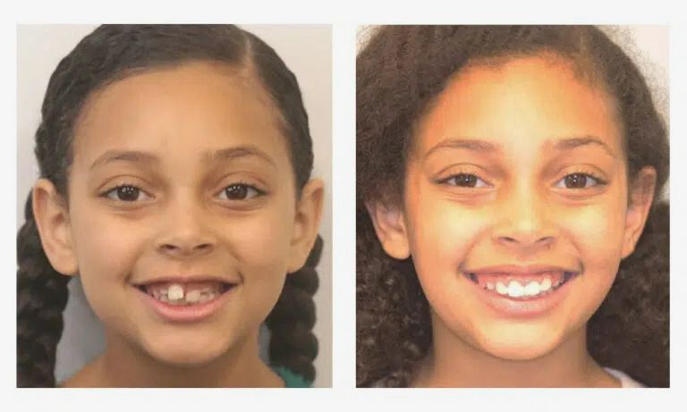 Before and after early orthodontics