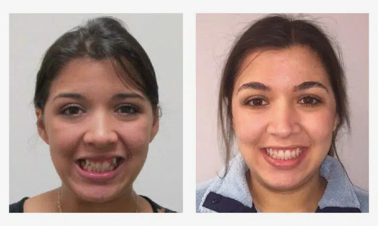 Before and after early orthodontics