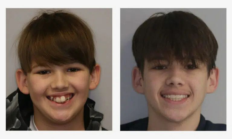 Before and after early orthodontics