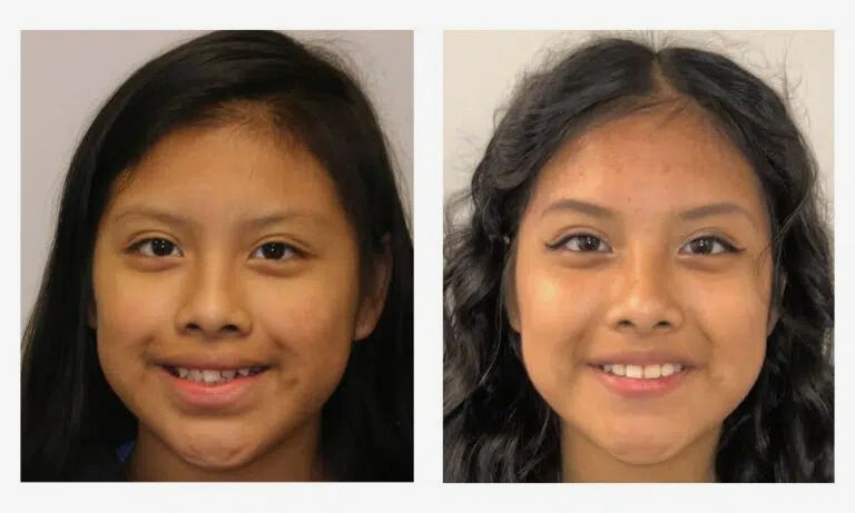 Before and after early orthodontics