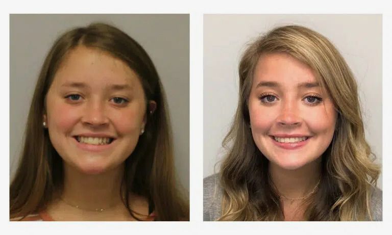 Before and after early orthodontics