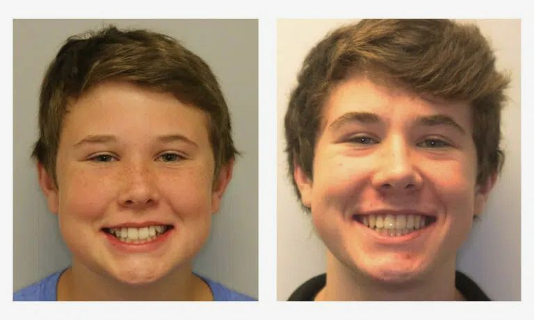 Before and after early orthodontics