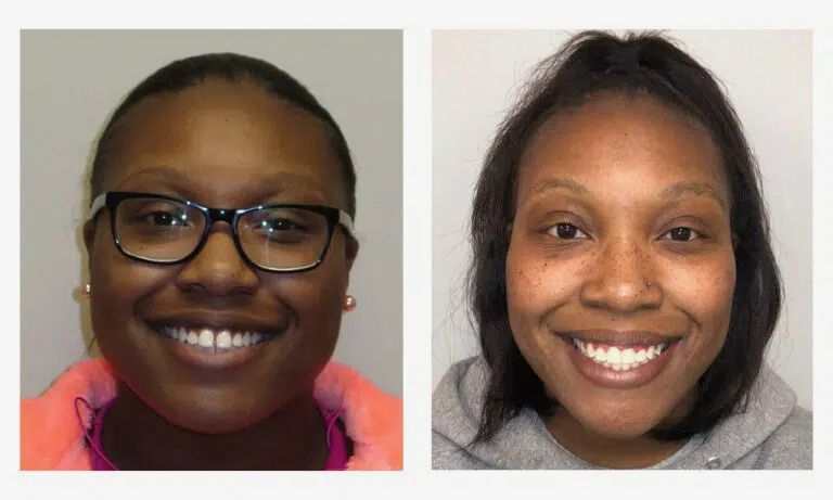 Before and after adult orthodontics