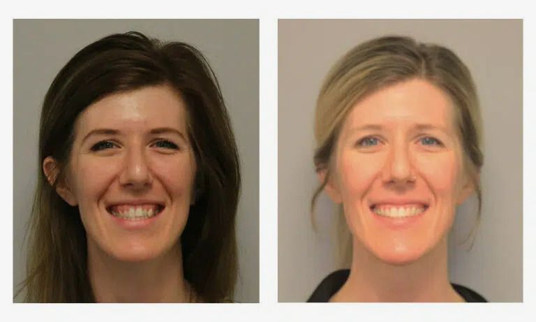 Before and after adult orthodontics