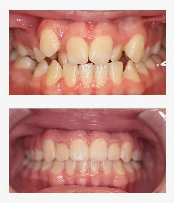 Before and after orthodontics treatment
