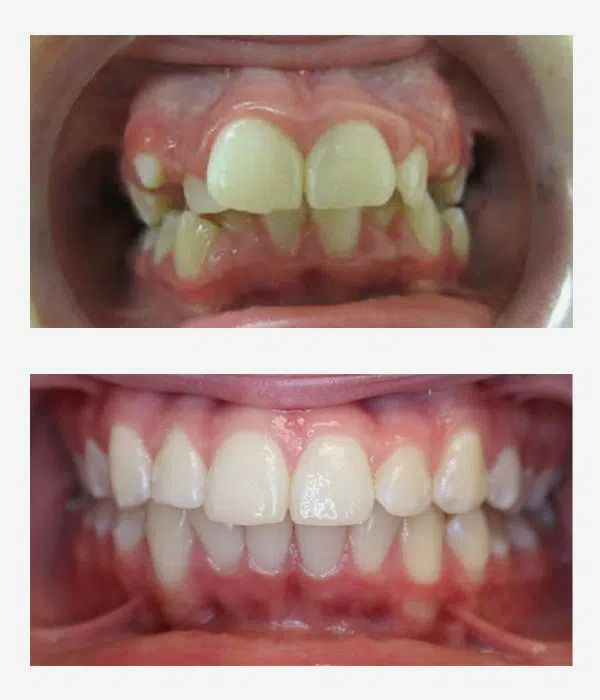 Before and after orthodontics treatment