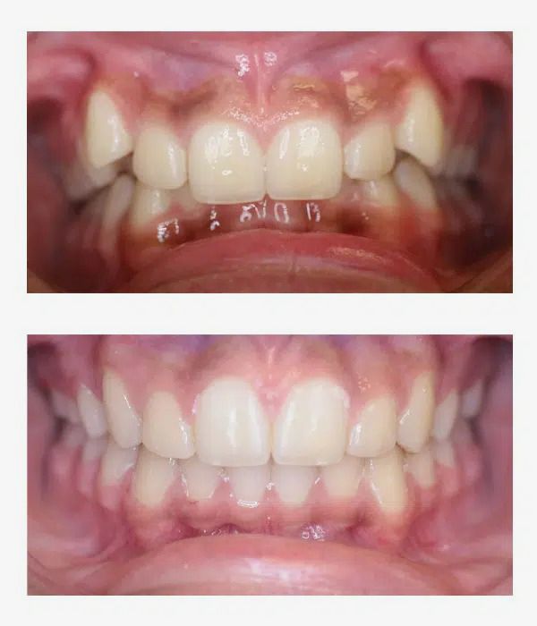 Before and after orthodontics treatment