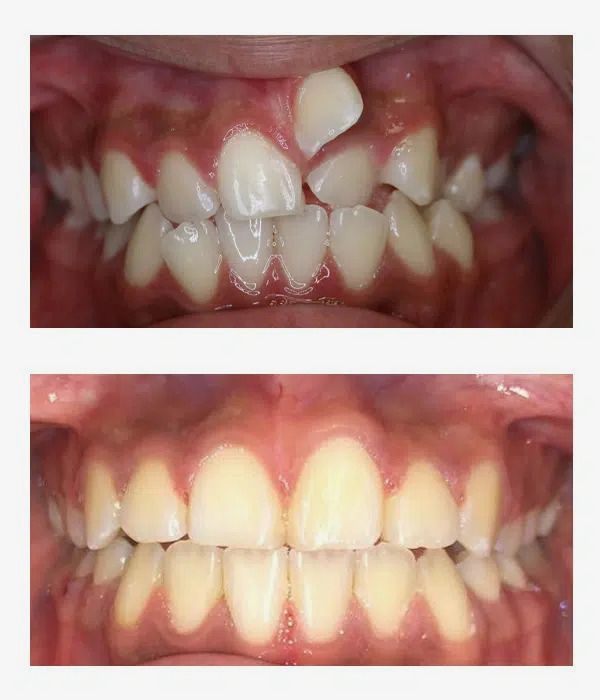 Before and after orthodontics treatment