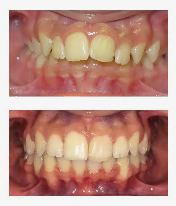 Before and after orthodontics treatment