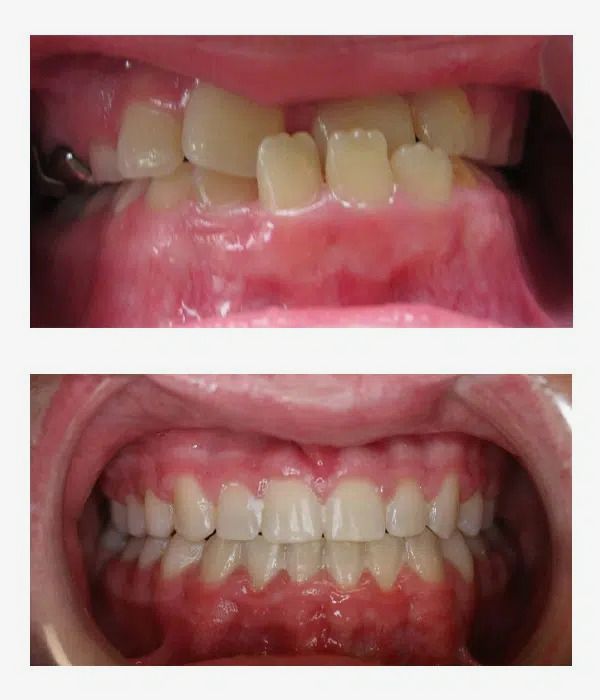 Before and after orthodontics treatment