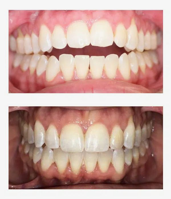 Before and after orthodontics treatment